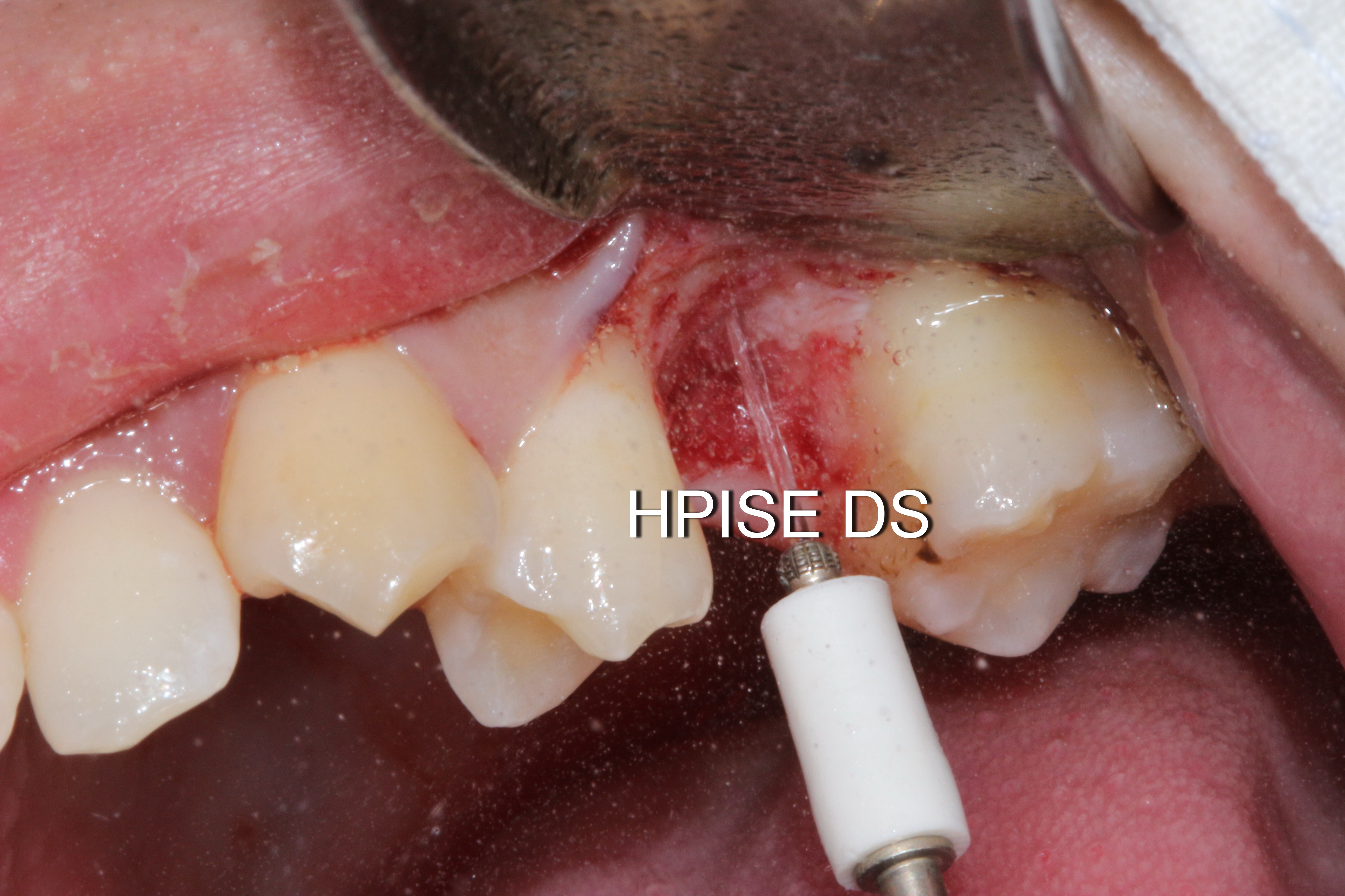 Simple sinus augmentation using HPISE and osteoinductive decalcified stikcy tooth bone